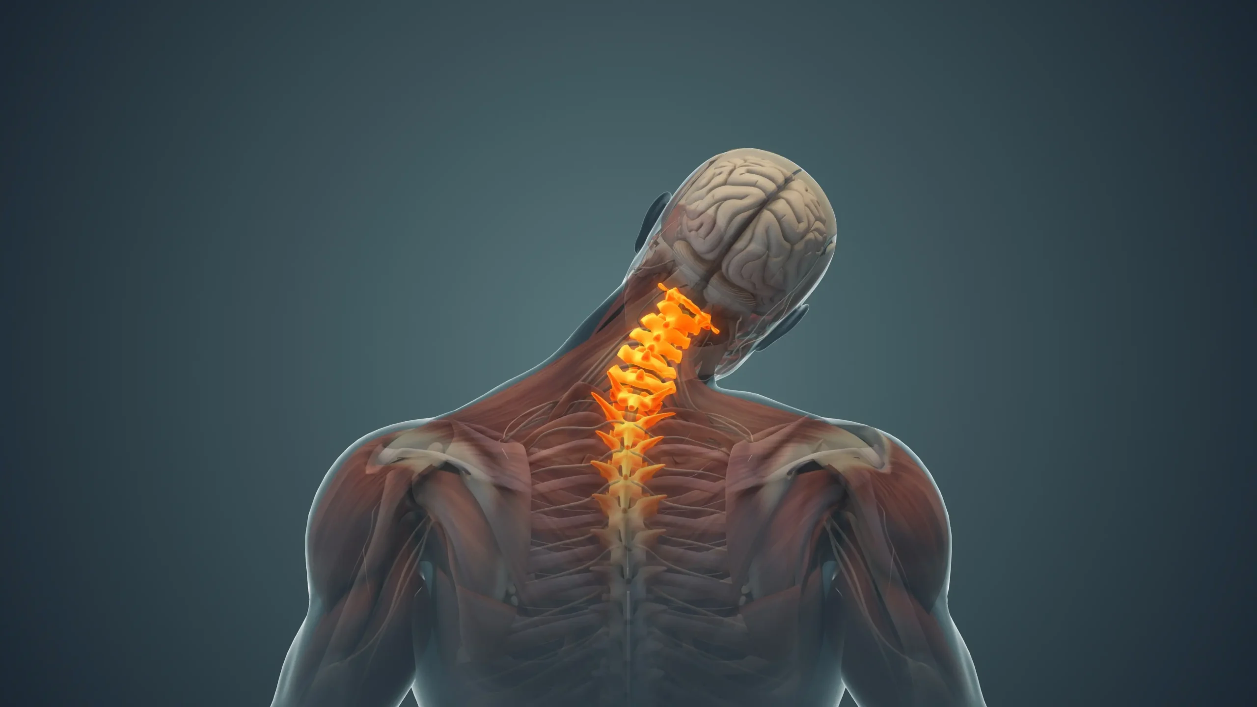 3D medical illustration of neck pain showing cervical spine muscles, tendons, and ligaments affected by soft tissue injury after a car accident